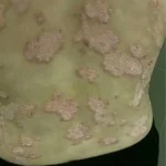 لوسیون ضد قارچ و ضد خارش آتونگجوهوا شوان‌ لی‌ جینگ