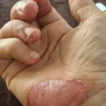 پماد اگزما و پسوریازیس