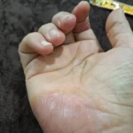 پماد اگزما و پسوریازیس