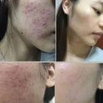 کیت دو مرحله‌ای ضد جوش قوی (سرم و کرم) نانتونگ