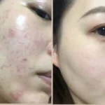 کیت دو مرحله‌ای ضد جوش قوی (سرم و کرم) نانتونگ
