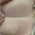 کیت ترمیم سه مرحله‌ای ترک‌های بارداری (استریا) نانتونگ