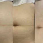کیت ترمیم سه مرحله‌ای ترک‌های بارداری (استریا) نانتونگ